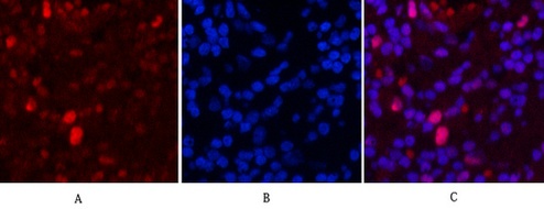 Fig.2. Immunofluorescence analysis of human lung cancer tissue. 1, PCNA Monoclonal Antibody (1D7) (red) was diluted at 1:200 (4°C, overnight). 2, Cy3 Labeled secondary antibody was diluted at 1:300 (room temperature, 50min). 3, Picture B: DAPI (blue) 10min. Picture A: Target. Picture B: DAPI. Picture C: merge of A+B.