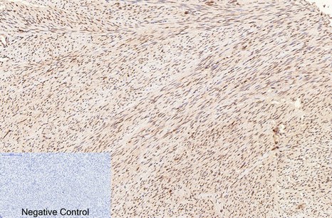 Fig.4. Immunohistochemical analysis of paraffin-embedded human uterus tissue. 1, PCNA Monoclonal Antibody (1D7) was diluted at 1:200 (4°C, overnight). 2, Sodium citrate pH 6.0 was used for antibody retrieval(>98°C, 20min). 3, secondary antibody was diluted at 1:200 (room temperature, 30min). Negative control was used by secondary antibody only.