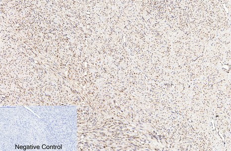 Fig.2. Immunohistochemical analysis of paraffin-embedded human uterus cancer tissue. 1, COX IV Monoclonal Antibody (14Y2) was diluted at 1:200 (4°C, overnight). 2, Sodium citrate pH 6.0 was used for antibody retrieval (>98°C, 20min). 3, secondary antibody was diluted at 1:200 (room temperature, 30min). Negative control was used by secondary antibody only.