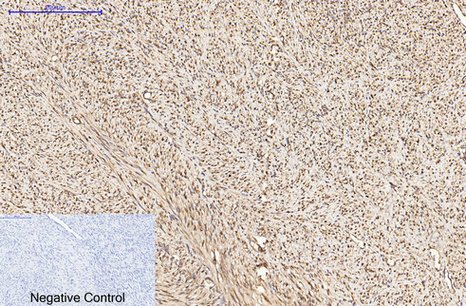 Fig.4. Immunohistochemical analysis of paraffin-embedded human uterus cancer tissue. 1, α-tubulin Monoclonal Antibody (3G5) was diluted at 1:200 (4°C, overnight). 2, Sodium citrate pH 6.0 was used for antibody retrieval (>98°C, 20min). 3, secondary antibody was diluted at 1:200 (room temperature, 30min). Negative control was used by secondary antibody only.