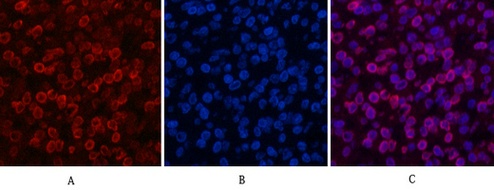 Fig.2 Immunofluorescence analysis of human lung cancer tissue. 1, Lamin B1 Monoclonal Antibody (15T1) (red) was diluted at 1:200 (4°C, overnight). 2, Cy3 Labeled secondary antibody was diluted at 1:300 (room temperature, 50min). 3, Picture B: DAPI (blue) 10min. Picture A: Target. Picture B: DAPI. Picture C: merge of A+B.