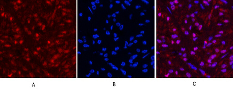 Fig.5. Immunofluorescence analysis of human breast cancer tissue. 1, HSP70 Monoclonal Antibody (red) was diluted at 1:200 (4°C, overnight). 2, Cy3 Labeled secondary antibody was diluted at 1:300 (room temperature, 50min). 3, Picture B: DAPI (blue) 10min. Picture A: Target. Picture B: DAPI. Picture C: merge of A+B.