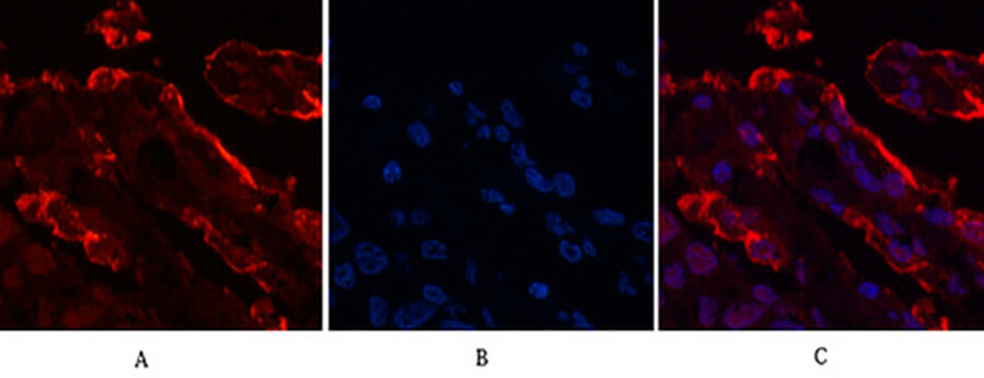 Fig.3. Immunofluorescence analysis of human lung cancer tissue. 1, Galectin-3 Monoclonal Antibody (red) was diluted at 1:200 (4°C, overnight). 2, Cy3 Labeled secondary antibody was diluted at 1:300 (room temperature, 50min). 3, Picture B: DAPI (blue) 10min. Picture A: Target. Picture B: DAPI. Picture C: merge of A+B.