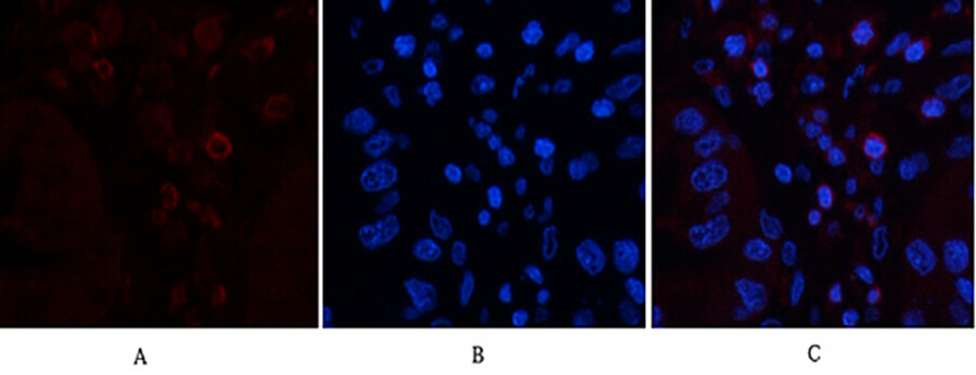 Fig.2. Immunofluorescence analysis of human liver cancer tissue. 1, CD45 Monoclonal Antibody  (red) was diluted at 1:200 (4°C, overnight). 2, Cy3 Labeled secondary antibody was diluted at 1:300 (room temperature, 50min). 3, Picture B: DAPI (blue) 10min. Picture A: Target. Picture B: DAPI. Picture C: merge of A+B.