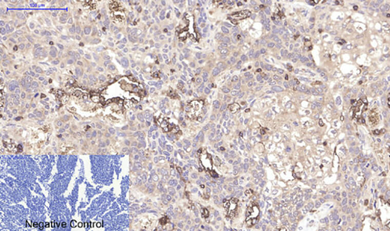 Fig.3. Immunohistochemical analysis of paraffin-embedded human lung cancer tissue. 1, CD45 Monoclonal Antibody was diluted at 1:200 (4°C, overnight). 2, Sodium citrate pH 6.0 was used for antibody retrieval (>98°C, 20min). 3, secondary antibody was diluted at 1:200 (room temperature, 30min). Negative control was used by secondary antibody only.