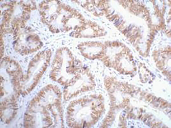 Fig.1. IHC-P staining of Human colon cancer tissue paraffin-embedded, diluted at 1:200.