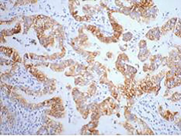 Fig.1. IHC-P staining of human lung cancer tissue, diluted at 1:200.