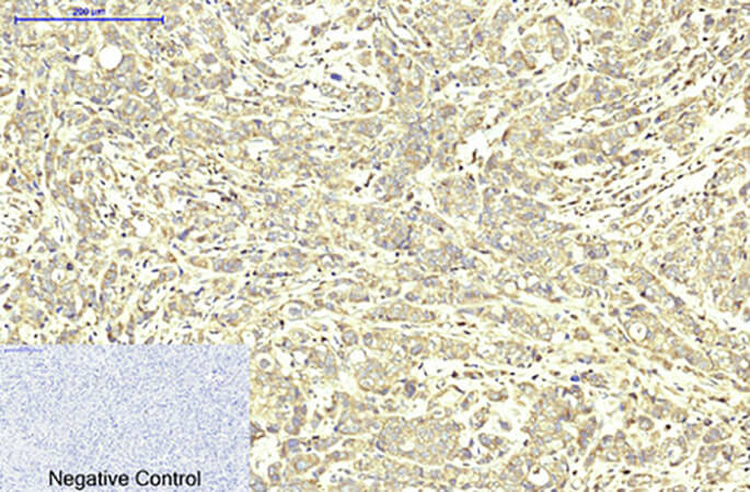 Fig.2. Immunohistochemical analysis of paraffin-embedded human breast cancer tissue. 1, ABCB5 Monoclonal Antibody was diluted at 1:200 (4°C, overnight). 2, Sodium citrate pH 6.0 was used for antibody retrieval (>98°C, 20min). 3, secondary antibody was diluted at 1:200 (room temperature, 30min). Negative control was used by secondary antibody only.