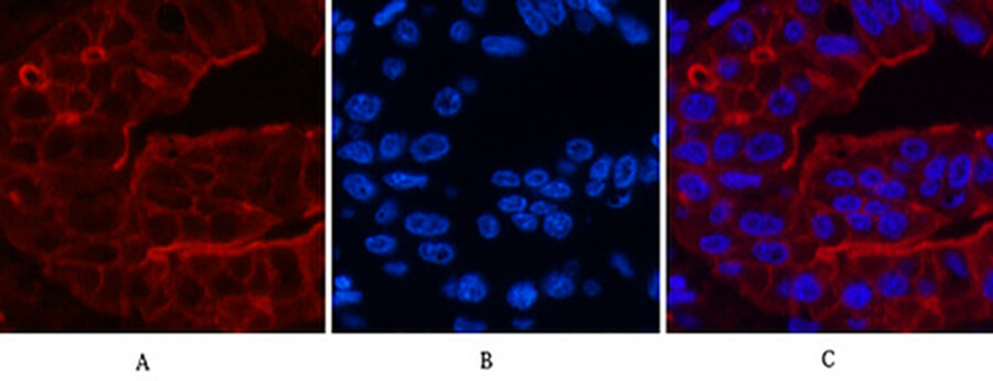 Fig.3. Immunofluorescence analysis of human liver cancer tissue. 1, ABCB5 Monoclonal Antibody (red) was diluted at 1:200 (4°C, overnight). 2, Cy3 Labeled secondary antibody was diluted at 1:300 (room temperature, 50min). 3, Picture B: DAPI (blue) 10min. Picture A: Target. Picture B: DAPI. Picture C: merge of A+B.