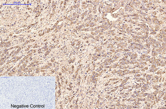 Fig.2. Immunohistochemical analysis of paraffin-embedded human breast cancer tissue. 1, AFP alpha 1 Fetoprotein Monoclonal Antibody was diluted at 1:200 (4°C, overnight). 2, Sodium citrate pH 6.0 was used for antibody retrieval (>98°C, 20min). 3, secondary antibody was diluted at 1:200 (room temperature, 30min). Negative control was used by secondary antibody only.
