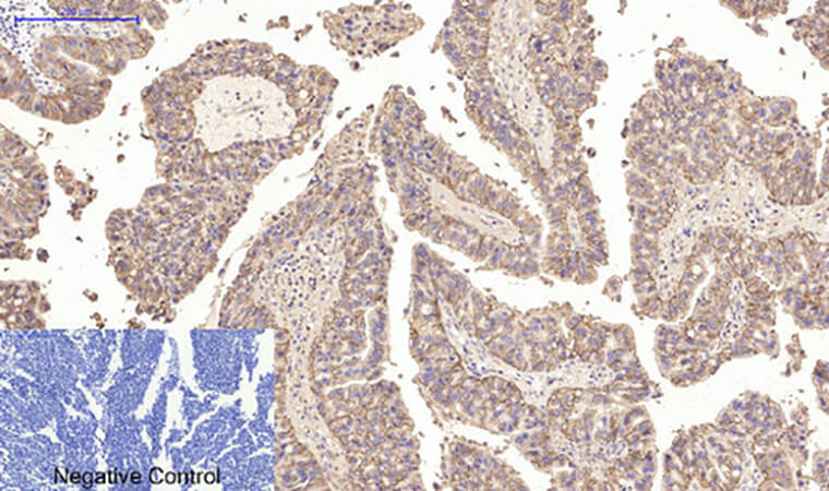 Fig.3. Immunohistochemical analysis of paraffin-embedded human lung cancer tissue. 1, CA IX Monoclonal Antibody  was diluted at 1:200 (4°C, overnight). 2, Sodium citrate pH 6.0 was used for antibody retrieval (>98°C, 20min). 3, secondary antibody was diluted at 1:200 (room temperature, 30min). Negative control was used by secondary antibody only.