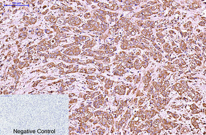 Fig.2. Immunohistochemical analysis of paraffin-embedded human breast cancer tissue. 1, CytokeRatin 6 Monoclonal Antibody was diluted at 1:200 (4°C, overnight). 2, Sodium citrate pH 6.0 was used for antibody retrieval (>98°C, 20min). 3, secondary antibody was diluted at 1:200 (room temperature, 30min). Negative control was used by secondary antibody only.