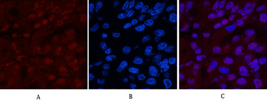 Fig.2. Immunofluorescence analysis of human liver cancer tissue. 1, XRCC4 Monoclonal Antibody (red) was diluted at 1:200 (4°C, overnight). 2, Cy3 Labeled secondary antibody was diluted at 1:300 (room temperature, 50min). 3, Picture B: DAPI (blue) 10min. Picture A: Target. Picture B: DAPI. Picture C: merge of A+B.