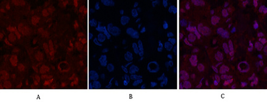Fig.2. Immunofluorescence analysis of human breast cancer tissue. 1, Oct1 Monoclonal Antibody (red) was diluted at 1:200 (4°C, overnight). 2, Cy3 Labeled secondary antibody was diluted at 1:300 (room temperature, 50min). 3, Picture B: DAPI (blue) 10min. Picture A: Target. Picture B: DAPI. Picture C: merge of A+B.