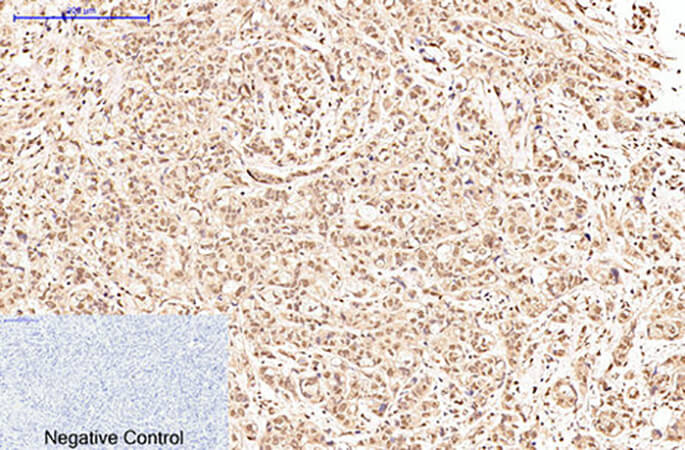 Fig.3. Immunohistochemical analysis of paraffin-embedded human breast cancer tissue. 1, Oct1 Monoclonal Antibody was diluted at 1:200 (4°C, overnight). 2, Sodium citrate pH 6.0 was used for antibody retrieval (>98°C, 20min). 3, secondary antibody was diluted at 1:200 (room temperature, 30min). Negative control was used by secondary antibody only.