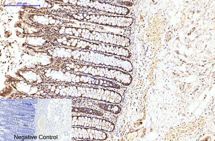 Fig.2. Immunohistochemical analysis of paraffin-embedded human colon cancer tissue. 1, eIF4A1 Monoclonal Antibody was diluted at 1:200 (4°C, overnight). 2, Sodium citrate pH 6.0 was used for antibody retrieval (>98°C, 20min). 3, secondary antibody was diluted at 1:200 (room temperature, 30min). Negative control was used by secondary antibody only.