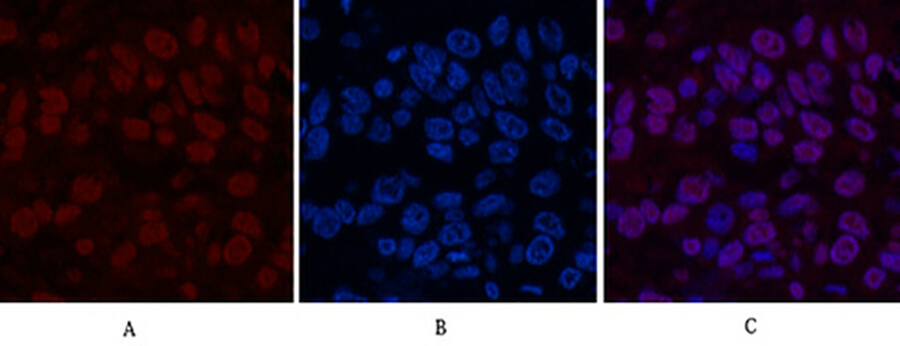 Fig.2. Immunofluorescence analysis of human lung cancer tissue. 1, Transferrin Monoclonal Antibody  (red) was diluted at 1:200 (4°C, overnight). 2, Cy3 Labeled secondary antibody was diluted at 1:300 (room temperature, 50min). 3, Picture B: DAPI (blue) 10min. Picture A: Target. Picture B: DAPI. Picture C: merge of A+B.