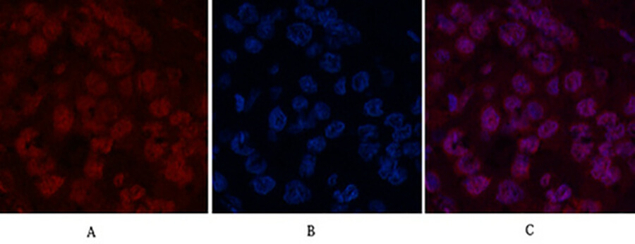 Fig.2. Immunofluorescence analysis of human liver cancer tissue. 1, Histone H2B Monoclonal Antibody (red) was diluted at 1:200 (4°C, overnight). 2, Cy3 Labeled secondary antibody was diluted at 1:300 (room temperature, 50min). 3, Picture B: DAPI (blue) 10min. Picture A: Target. Picture B: DAPI. Picture C: merge of A+B.
