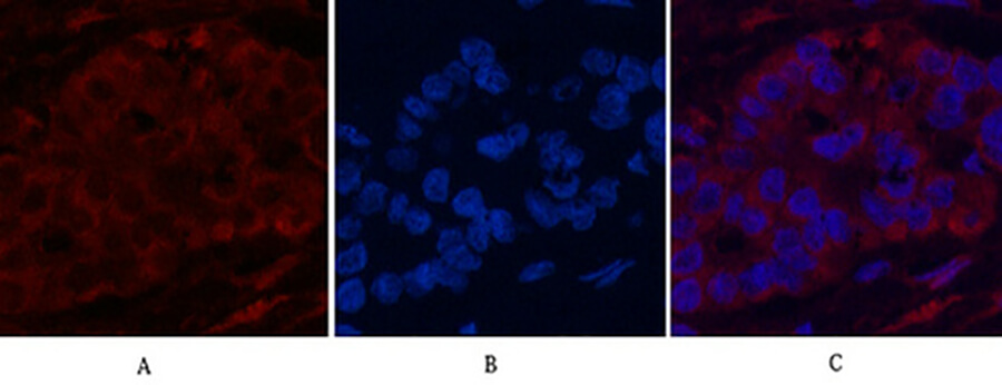 Fig.5. Immunofluorescence analysis of human liver cancer tissue. 1, CYCS Monoclonal Antibody (red) was diluted at 1:200 (4°C, overnight). 2, Cy3 Labeled secondary antibody was diluted at 1:300 (room temperature, 50min). 3, Picture B: DAPI (blue) 10min. Picture A: Target. Picture B: DAPI. Picture C: merge of A+B.