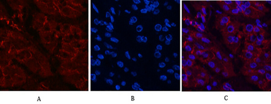 Fig.4. Immunofluorescence analysis of human stomach cancer tissue. 1, Catenin-β Monoclonal Antibody  (red) was diluted at 1:200 (4°C, overnight). 2, Cy3 Labeled secondary antibody was diluted at 1:300 (room temperature, 50min). 3, Picture B: DAPI (blue) 10min. Picture A: Target. Picture B: DAPI. Picture C: merge of A+B.