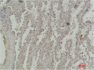 Fig.2. Immunohistochemical analysis of paraffin-embedded Human Lung Carcinoma using CREB-1 Monoclonal Antibody.