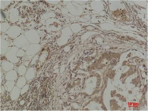 Fig.2. Immunohistochemical analysis of paraffin-embedded Human Breast Carcinoma using Pan Methylated Lysine Monoclonal Antibody.