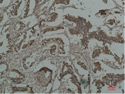 Fig.2. Immunohistochemical analysis of paraffin-embedded Human Breast Caricnoma using HSP27Mouse mAb diluted at 1:200.