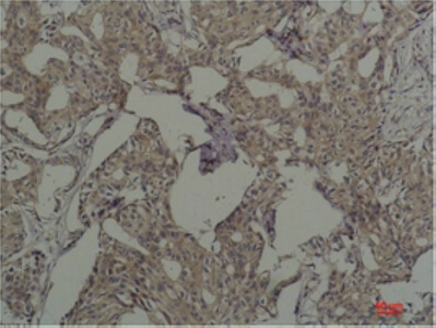Fig.2. Immunohistochemical analysis of paraffin-embedded Human Breast Caricnoma using c-FosMouse mAb diluted at 1:200.
