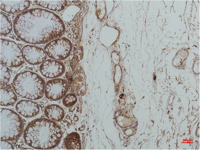 Fig.2. Immunohistochemical analysis of paraffin-embedded Human Colon Caricnoma using GRP78/BipMouse mAb diluted at 1:200.