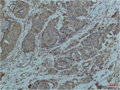 Fig.3. Immunohistochemical analysis of paraffin-embedded Human Breast Caricnoma using GRP78/BipMouse mAb diluted at 1:200.