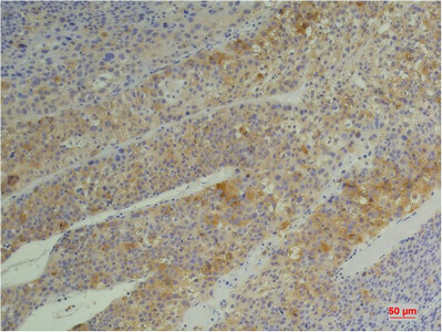 Fig.2. Immunohistochemical analysis of paraffin-embedded Human Heptacarcinoma using Cyclophilin BMouse mAb diluted at 1:200.