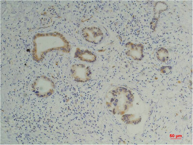 Fig.3. Immunohistochemical analysis of paraffin-embedded Human Pancreatic Carcinoma using Cyclophilin BMouse mAb diluted at 1:200.