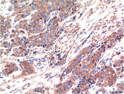 Fig.3. Immunohistochemical analysis of paraffin-embedded Human Breast Carcinoma Tissue using Bax Mouse mAb diluted at 1:200.