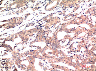 Fig.1. Immunohistochemical analysis of paraffin-embedded Human Breast Carcinoma Tissue using GSK3β Mouse mAb diluted at 1:200.
