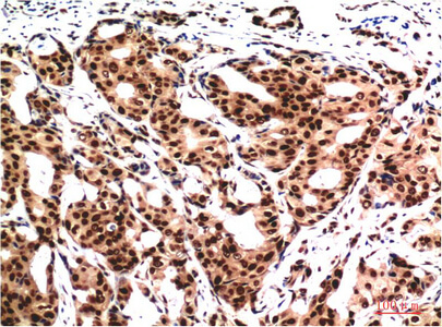 Fig.1. Immunohistochemical analysis of paraffin-embedded Human Breast CarcinomaTissue using Ubiquitin Mouse mAb diluted at 1:200.