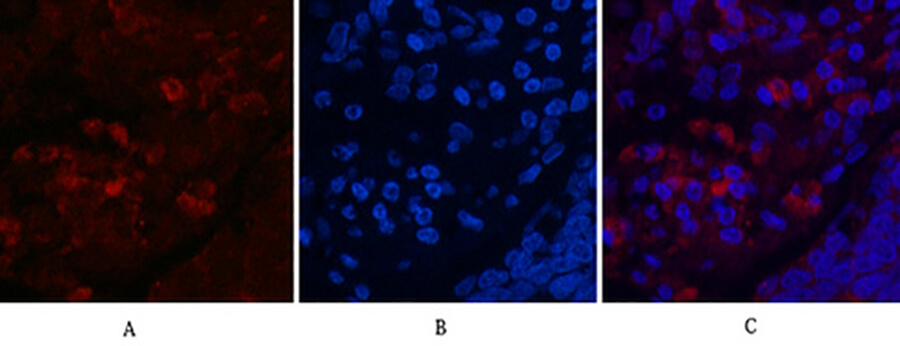Fig.1. Immunofluorescence analysis of human lung cancer tissue. 1, LC3A Mouse Monoclonal Antibody (5G10) (red) was diluted at 1:200 (4°C, overnight). 2, Cy3 Labeled secondary antibody was diluted at 1:300 (room temperature, 50min). 3, Picture B: DAPI (blue) 10min. Picture A: Target. Picture B: DAPI. Picture C: merge of A+B.