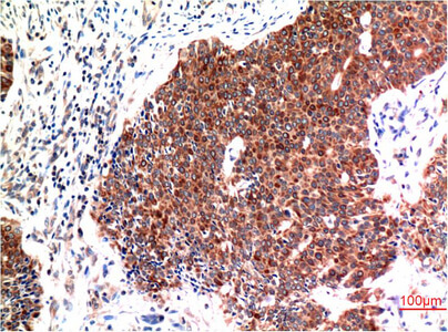 Fig.2. Immunohistochemical analysis of paraffin-embedded Human Breast Carcinoma Tissue using Beclin-1 Mouse mAb diluted at 1:200.