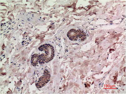 Fig.2. Immunohistochemical analysis of paraffin-embedded Human Breast Carcinoma Tissue using Smad3 Mouse mAb diluted at 1:200.