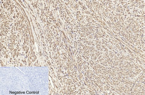 Fig.3. Immunohistochemical analysis of paraffin-embedded human uterus cancer tissue. 1, β I tubulin Monoclonal Antibody was diluted at 1:200 (4°C, overnight). 2, Sodium citrate pH 6.0 was used for antibody retrieval (>98°C, 20min). 3, secondary antibody was diluted at 1:200 (room temperature, 30min). Negative control was used by secondary antibody only.