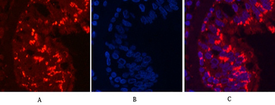 Fig.3. Immunofluorescence analysis of human lung cancer tissue. 1, CD68 Monoclonal Antibody (red) was diluted at 1:200 (4°C, overnight). 2, Cy3 Labeled secondary antibody was diluted at 1:300 (room temperature, 50min). 3, Picture B: DAPI (blue) 10min. Picture A: Target. Picture B: DAPI. Picture C: merge of A+B.