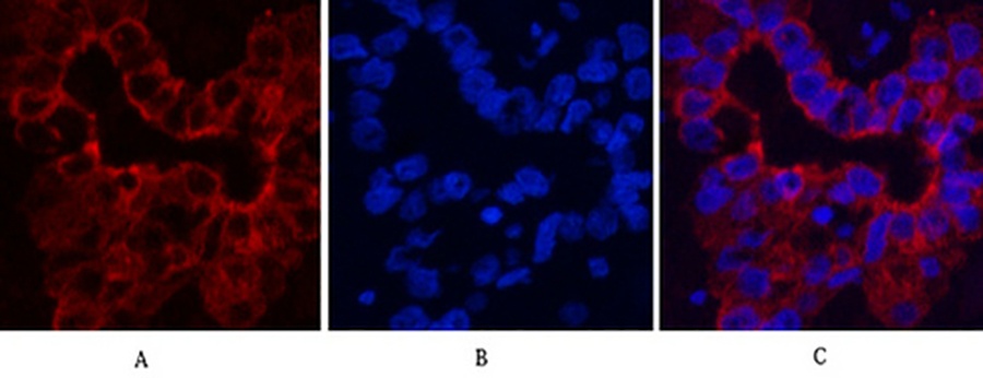 Fig.3. Immunofluorescence analysis of human liver cancer tissue. 1, CK16 Monoclonal Antibody (red) was diluted at 1:200 (4°C, overnight). 2, Cy3 Labeled secondary antibody was diluted at 1:300 (room temperature, 50min). 3, Picture B: DAPI (blue) 10min. Picture A: Target. Picture B: DAPI. Picture C: merge of A+B.