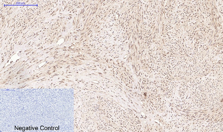 Fig.3. Immunohistochemical analysis of paraffin-embedded human uterus tissue. 1, CD10 Monoclonal Antibody was diluted at 1:200 (4°C, overnight). 2, Sodium citrate pH 6.0 was used for antibody retrieval (>98°C, 20min). 3, secondary antibody was diluted at 1:200 (room temperature, 30min). Negative control was used by secondary antibody only.