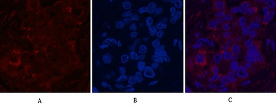 Fig.5. Immunofluorescence analysis of human liver cancer tissue. 1, FH Monoclonal Antibody (red) was diluted at 1:200 (4°C, overnight). 2, Cy3 Labeled secondary antibody was diluted at 1:300 (room temperature, 50min). 3, Picture B: DAPI (blue) 10min. Picture A: Target. Picture B: DAPI. Picture C: merge of A+B.