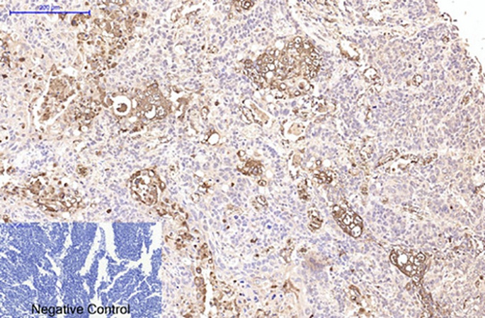 Fig.1. Immunohistochemical analysis of paraffin-embedded human lung cancer tissue. 1, CD15 Monoclonal Antibody was diluted at 1:200 (4°C, overnight). 2, Sodium citrate pH 6.0 was used for antibody retrieval (>98°C, 20min). 3, secondary antibody was diluted at 1:200 (room temperature, 30min). Negative control was used by secondary antibody only.