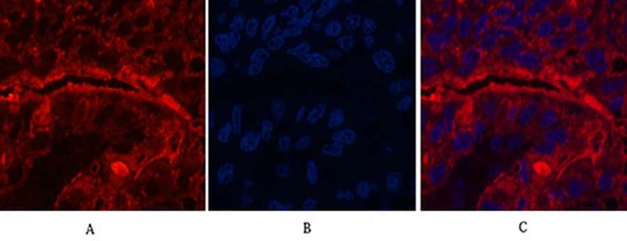 Fig.2. Immunofluorescence analysis of human liver cancer tissue. 1, CD15 Monoclonal Antibody (red) was diluted at 1:200 (4°C, overnight). 2, Cy3 Labeled secondary antibody was diluted at 1:300 (room temperature, 50min). 3, Picture B: DAPI (blue) 10min. Picture A: Target. Picture B: DAPI. Picture C: merge of A+B.