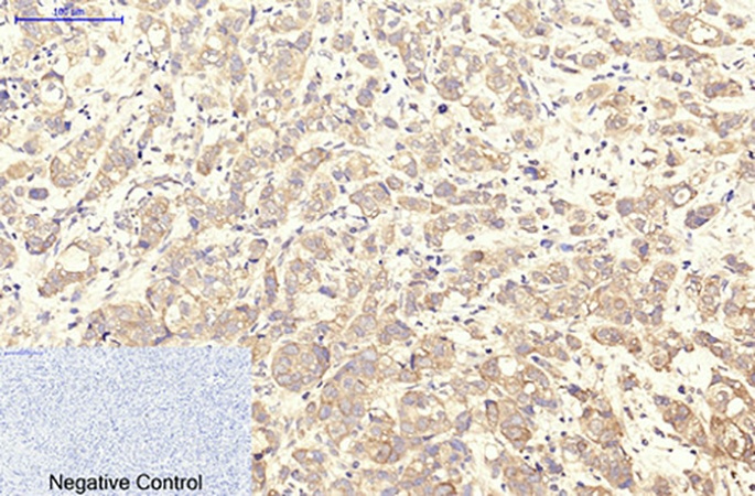 Fig.1. Immunohistochemical analysis of paraffin-embedded human breast cancer tissue. 1, CD41 Monoclonal Antibody was diluted at 1:200 (4°C, overnight). 2, Sodium citrate pH 6.0 was used for antibody retrieval (>98°C, 20min). 3, secondary antibody was diluted at 1:200 (room temperature, 30min). Negative control was used by secondary antibody only.