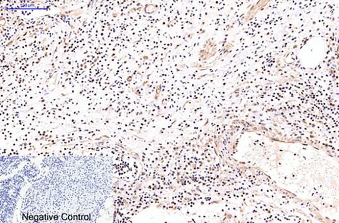 Fig.3. Immunohistochemical analysis of paraffin-embedded human appendix tissue. 1, NFkB p65 Monoclonal Antibody was diluted at 1:200 (4°C, overnight). 2, Sodium citrate pH 6.0 was used for antibody retrieval (>98°C, 20min). 3, secondary antibody was diluted at 1:200 (room temperature, 30min). Negative control was used by secondary antibody only.