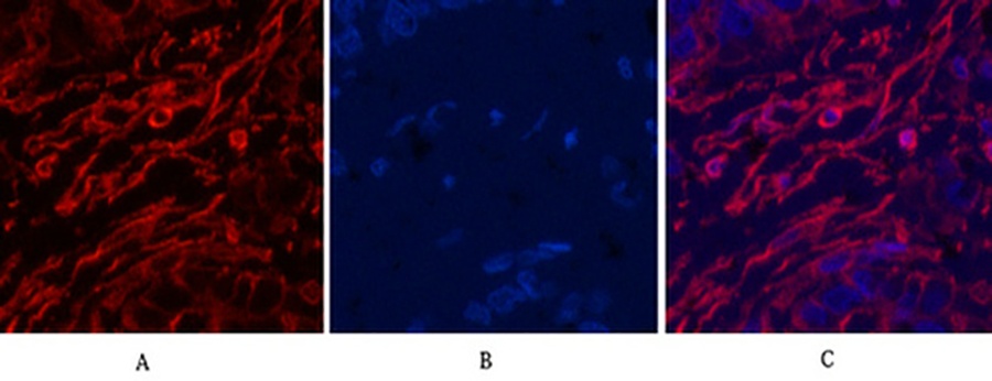 Fig.2. Immunofluorescence analysis of human liver cancer tissue. 1, α skeletal muscle actin Monoclonal Antibody (red) was diluted at 1:200 (4°C, overnight). 2, Cy3 Labeled secondary antibody was diluted at 1:300 (room temperature, 50min). 3, Picture B: DAPI (blue) 10min. Picture A: Target. Picture B: DAPI. Picture C: merge of A+B.