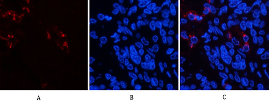 Fig.1. Immunofluorescence analysis of human lung cancer tissue. 1, Lactoferrin Monoclonal Antibody (red) was diluted at 1:200 (4°C, overnight). 2, Cy3 Labeled secondary antibody was diluted at 1:300 (room temperature, 50min). 3, Picture B: DAPI (blue) 10min. Picture A: Target. Picture B: DAPI. Picture C: merge of A+B.