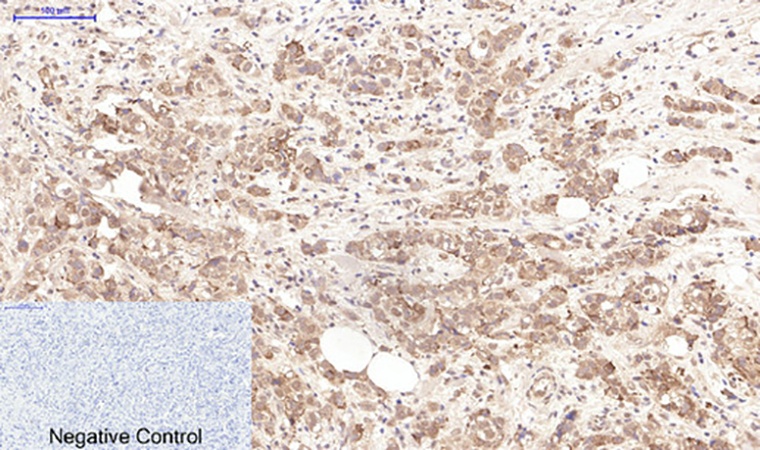 Fig.2. Immunohistochemical analysis of paraffin-embedded human breast cancer tissue. 1, Lactoferrin Monoclonal Antibody was diluted at 1:200 (4°C, overnight). 2, Sodium citrate pH 6.0 was used for antibody retrieval (>98°C, 20min). 3, secondary antibody was diluted at 1:200 (room temperature, 30min). Negative control was used by secondary antibody only.